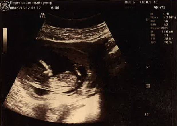 фото человеческий эмбрион